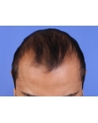 Before Hair Transplant&nbsp;2 Sessions (Areas)